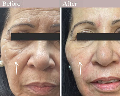 cheek fillers before after nyc